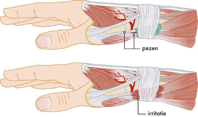 Duimspalk Brace en Pols Spalk